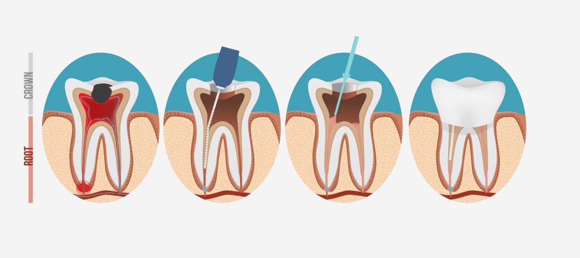 Root Canal Treatment Perth Genesis Dental