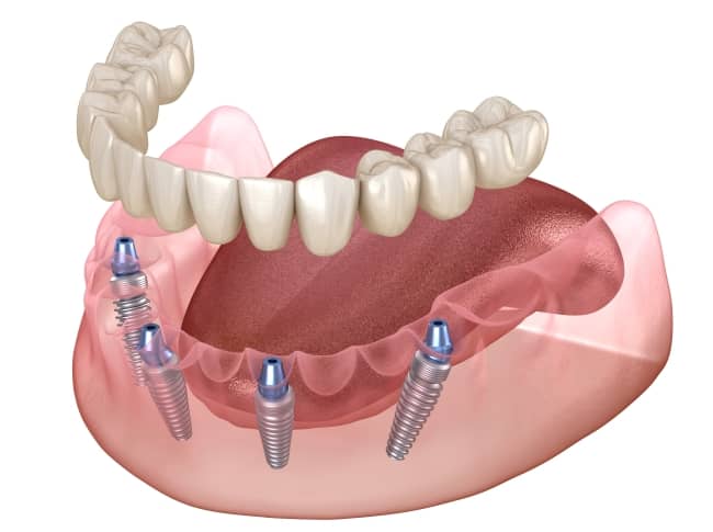 All-on-4 implants provide a reliable option for many patients with missing teeth.