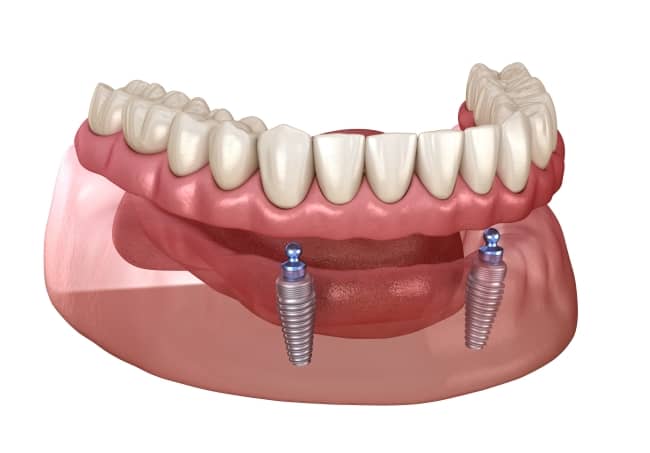 A complete denture can be supported and secured with implants.
