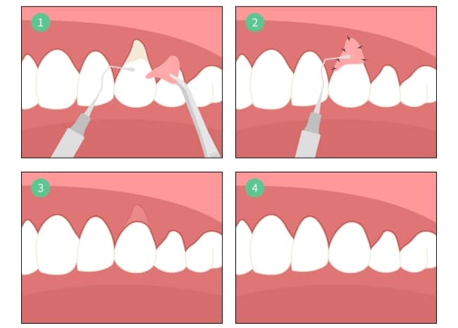 A qualified dentist can take a small piece of gum tissue from somewhere else in your mouth and attach it where required.