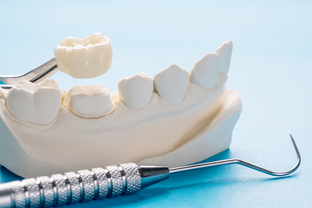 image showing types of dental bridges