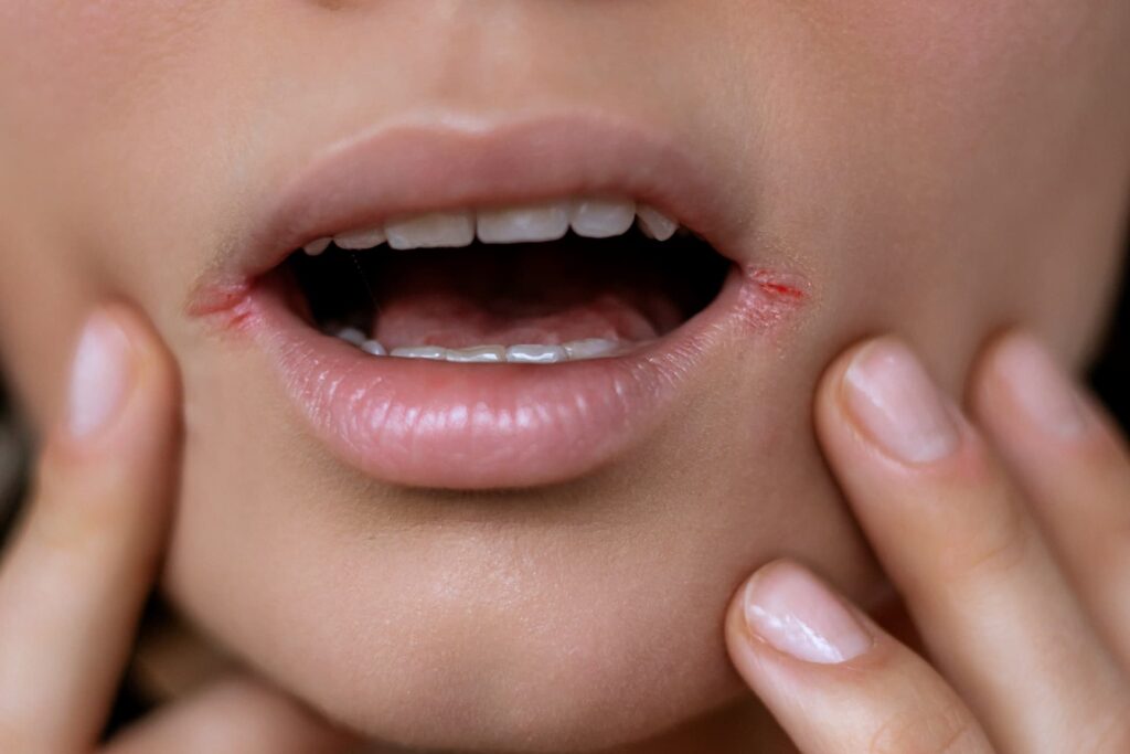 Woman experiencing common causes of dry mouth